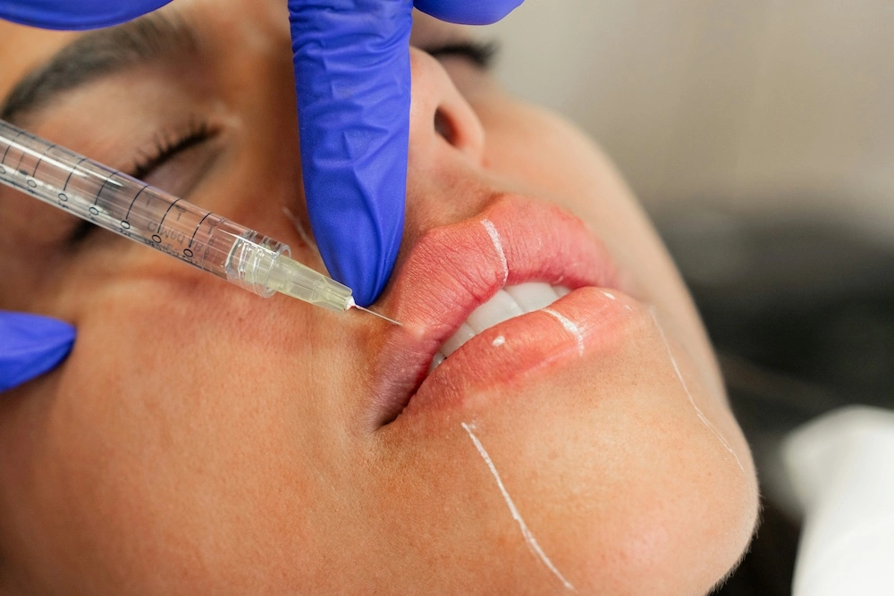 dermal fillers in bristol