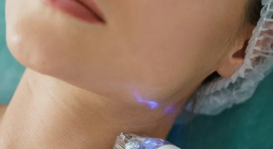 microneedling bristol